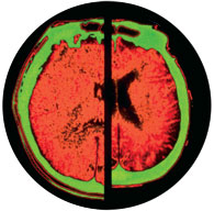 On the left, a normal brain; on the right, a brain shrunken and ravaged by Alzheimer’s. Researchers predict that the disease will affect almost 600,000 people by 2025, double the current number of victims in Canada.